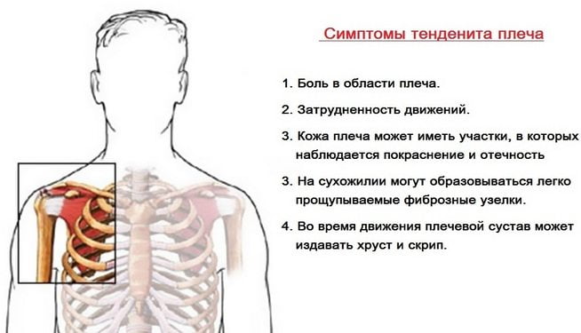 Симптомы тендинита плечевого сустава Симптомы тендинита плеча