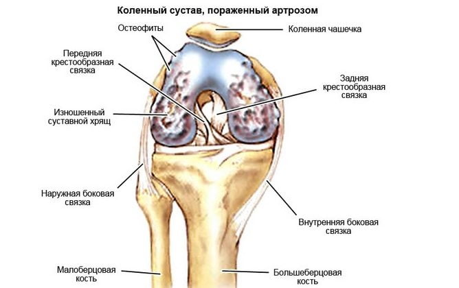 Коленный сустав, пораженный артрозом Артроз коленного сустава