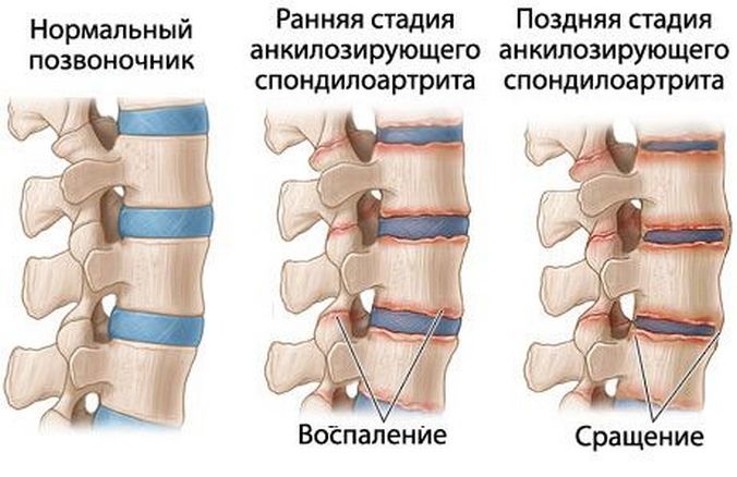 Здоровый и пораженный ювенильным анкилозирующим спондилоартритом позвоночник Ювенильный анкилозирующий спондилоартрит