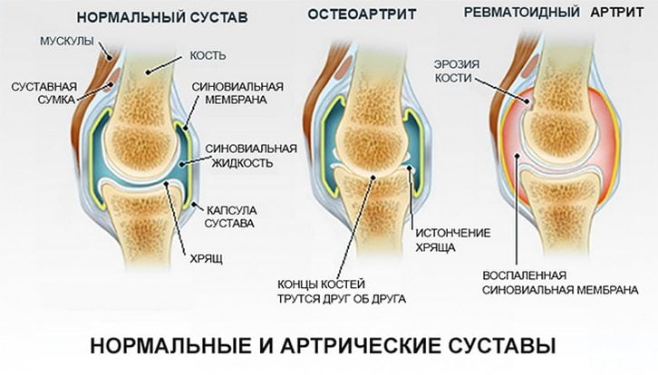 Здоровый и пораженные артритом суставы Артриты суставов