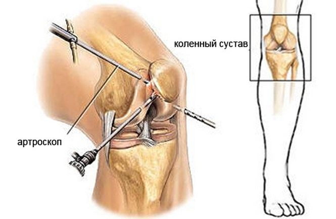 Артроскопия колена Что такое артроскопия коленного сустава