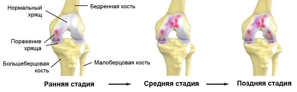 Стадии артроза коленного сустава Стадии коленного артроза