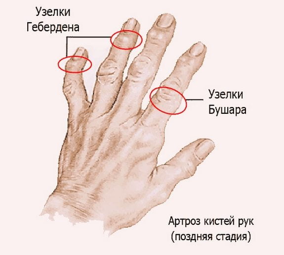 3 стадия артроза суставов кисти руки Артроз кисти 3 стадии