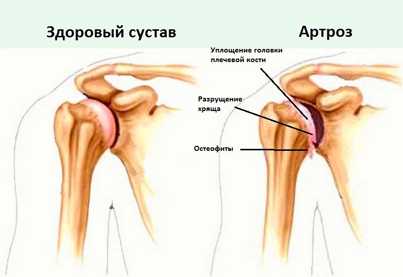 Здоровый и пораженный артрозом сустав Артроз плечевого сустава