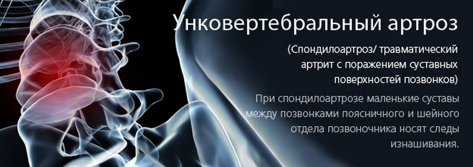 Унковертебральный артроз Ункоартроз