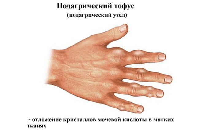 Подагрические тофусы кисти Подагра кисти