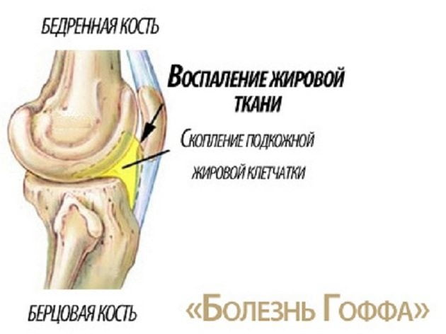 Болезнь Гоффа коленного сустава Болезнь Гоффа