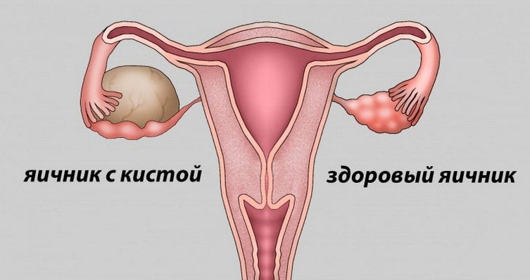 Здоровый яичник и яичник с кистой Киста яичника
