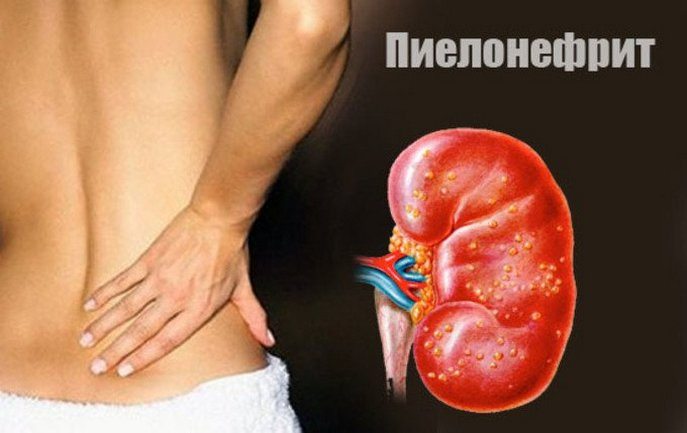 Боль в пояснице при пиелонефрите Пиелонефрит