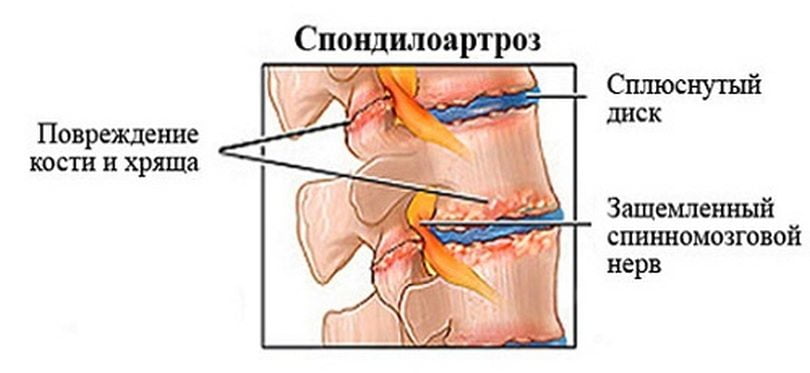 Анкилозирующий спондилоартроз поясничного отдела позвоночника Спондилоартроз