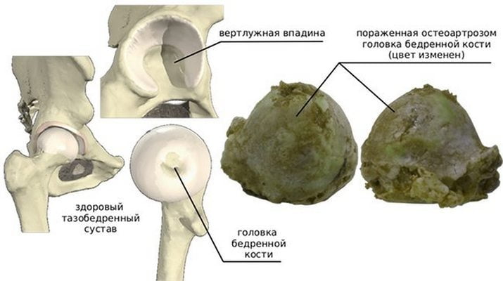 Здоровый ТБС и пораженная остеоартрозом головка бедренной кости Остеоартроз тазобедренного сустава