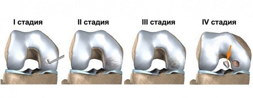 Стадии развития болезни Кенига Стадии болезни Кенига
