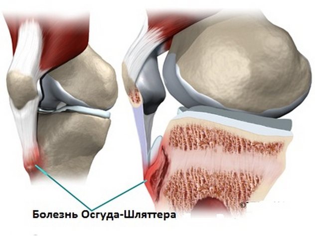 Болезнь Осгуда-Шлаттера коленного сустава Болезнь Осгуда Шлаттера