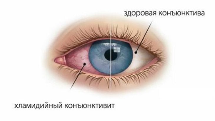 Хламидийный конъюнктивит Конъюнктивит