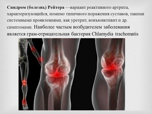 Описание болезни Рейтера Описание болезни Рейтера