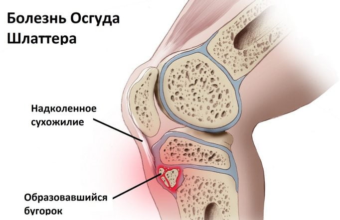 Болезнь Осгуда Шлаттера Болезнь Шляттера