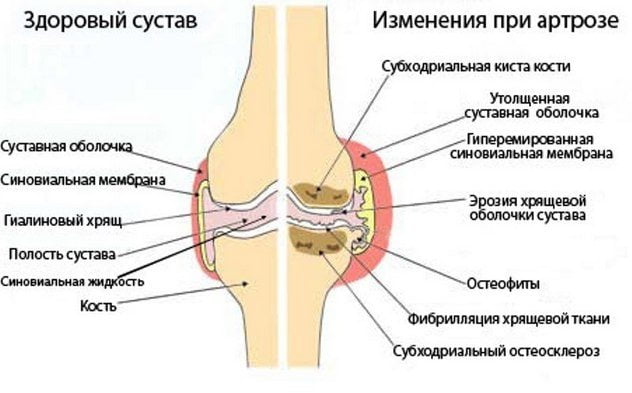 Разница между здоровым суставом и суставом при артрозе Артроз сустава
