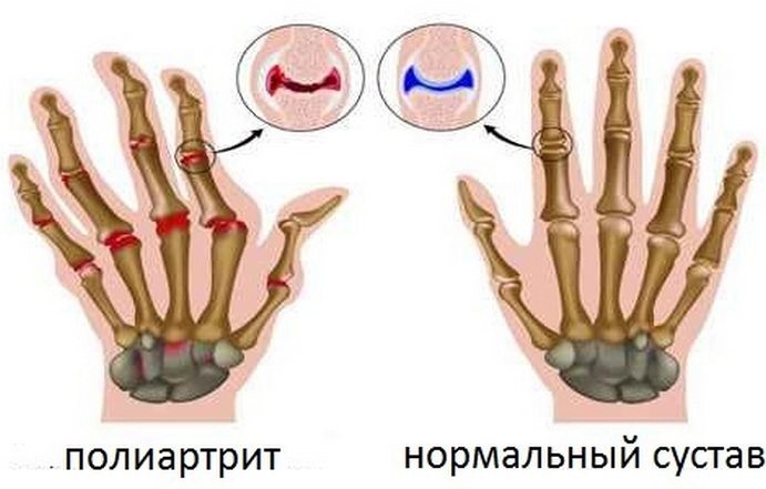 Здоровые и пораженные полиартритом суставы кисти руки Полиартрит суставов