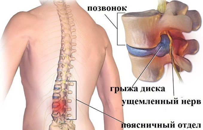 Грыжа поясничного отдела позвоночника Грыжа поясницы