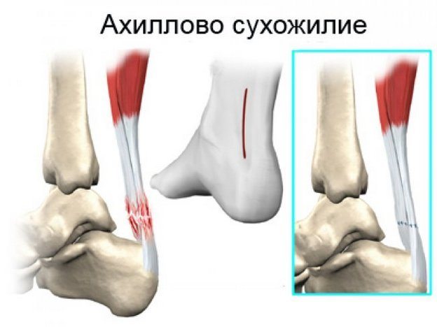 Разрыв пяточного(ахиллова) сухожилия Разрыв пяточного сухожилия