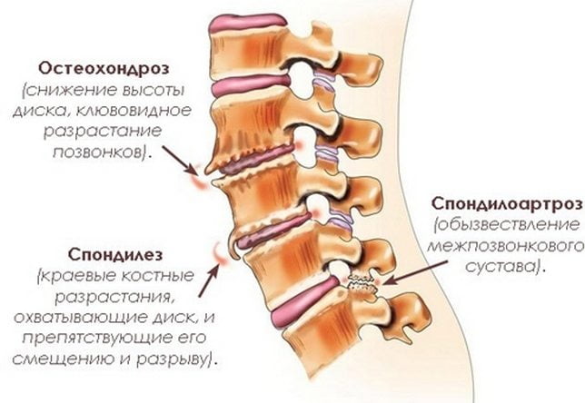 Болезни вызывающие боли в шее Болезни позвоночника