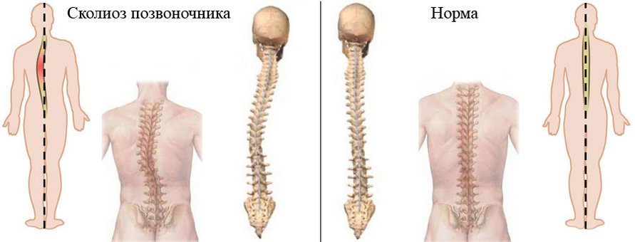 Здоровый и пораженный сколиозом позвоночник Сколиоз позвоночника