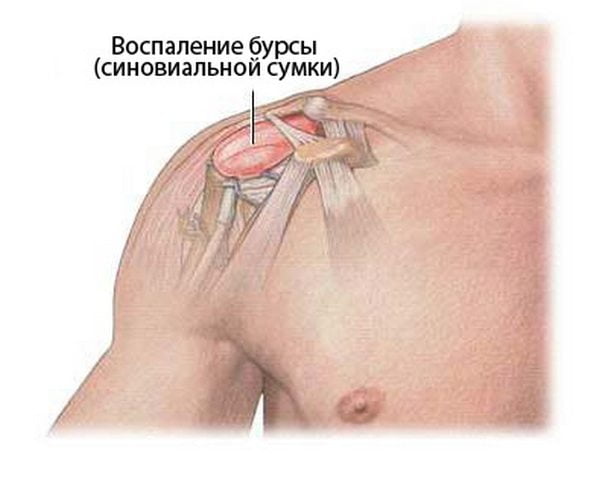 Воспаление бурсы плечевого сустава Бурсит плечевого сустава
