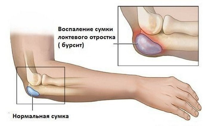 Здоровая и воспаленная сумка локтевого отростка Бурсит локтевого сустава