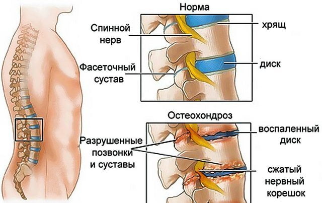 Остеохондроз поясничного отдела Остеохондроз