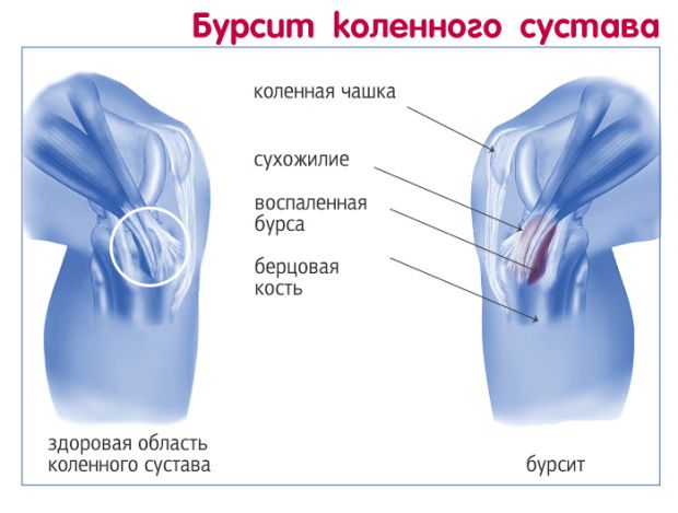Здоровый и пораженный бурситом коленный сустав Бурсит колена