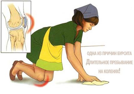 Причина появления бурсита коленного сустава Причины бурсита