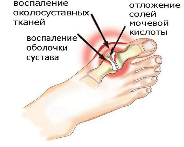 Стопа пораженная подагрой Подагра