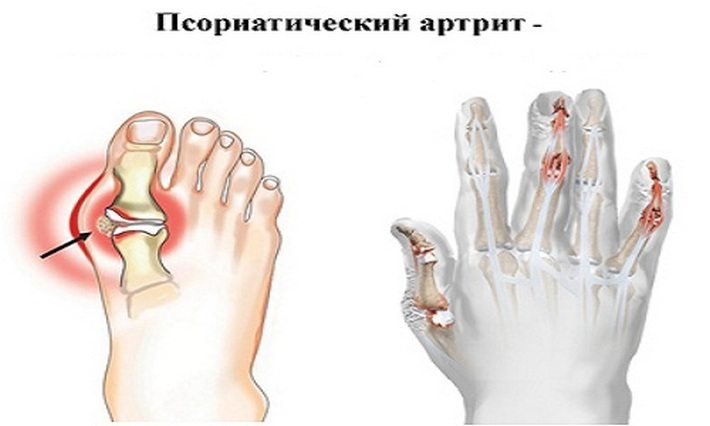 Ювенильный псориатический артрит Псориатический артрит