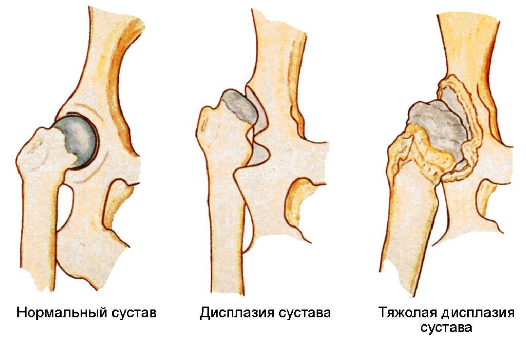 Здоровый тазобедренный сустав и дисплазия разной степени Дисплазия тазобедренного сустава