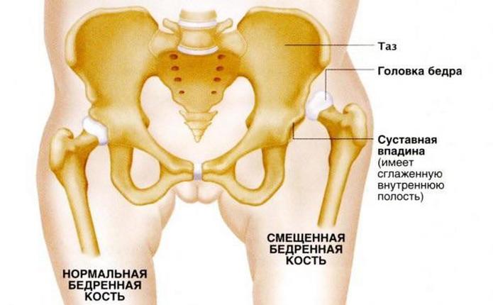 Здоровая и смещенная бедренная кость при дисплазии Смещение бедренной кости при дисплазии