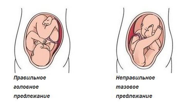 Правильное и неправильное предлежание плода Неправильное предлежание плода