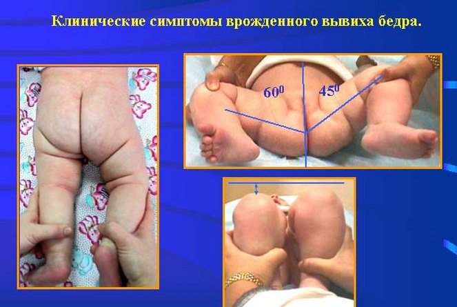 Характерные симптомы дисплазии тазобедренного сочленения у малыша Симптомы дисплазии