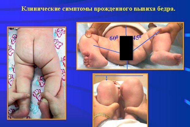 Симптомы дисплазии тазобедренного сустава Симптомы дисплазии