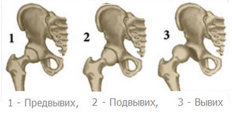 Стадии дисплазии тазобедренного сустава Стадии дисплазии