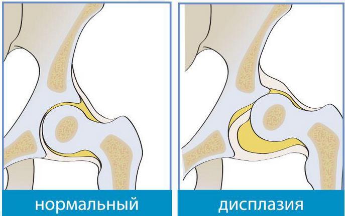 Здоровый и пораженный дисплазией тазобедренный сустав Дисплазия тазобедренного сустава