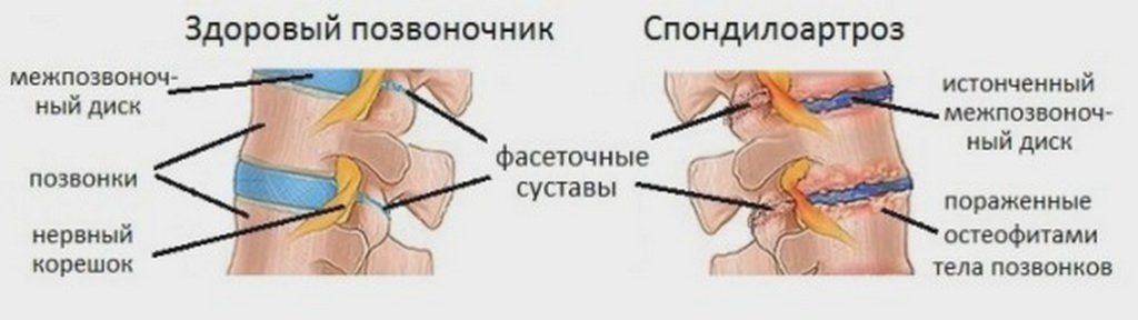 Здоровый и пораженный спондилоартрозом позвоночник Спондилоартроз