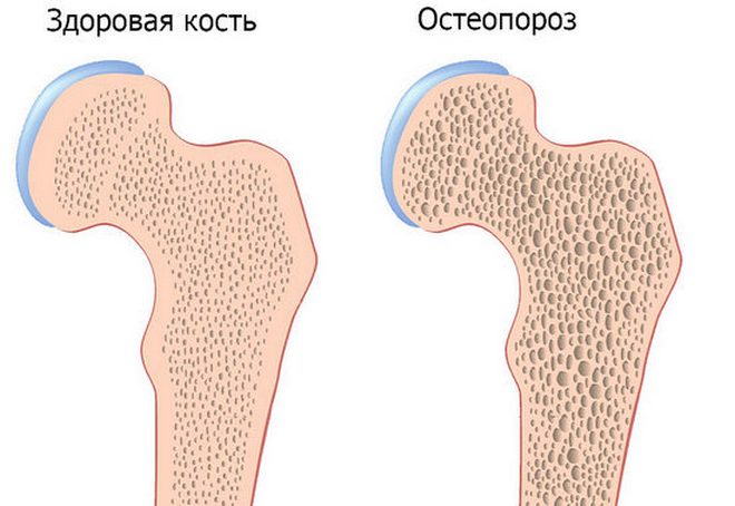 Здоровая и пораженная остеопорозом кость Остеопороз
