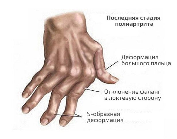 Последняя стадия полиартрита пальцев руки Последняя стадия полиартрита