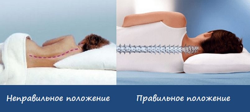 Правильное положение для сна при шейном остеохондрозе Правильное положение для сна