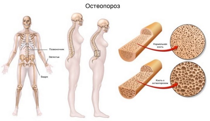 Здоровая и пораженная остеопорозом кость Остеопороз