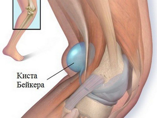 Киста Бейкера коленного сустава Киста Бейкера