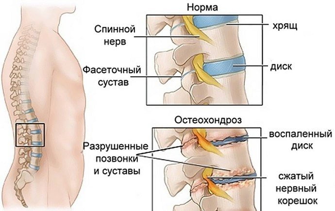 Здоровые и пораженные остеохондрозом позвонки Остеохондроз