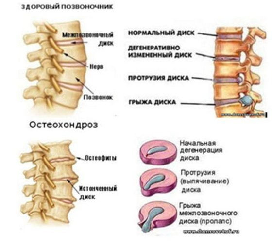 Здоровый и пораженный остеохондрозом позвоночник Остеохондроз позвоночника