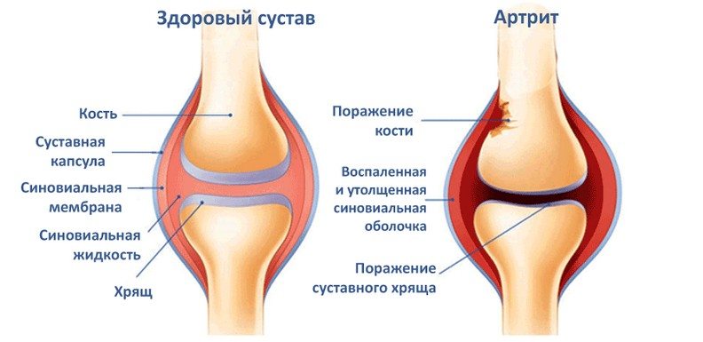 Здоровый и пораженный артритом сустав Артрит сустава