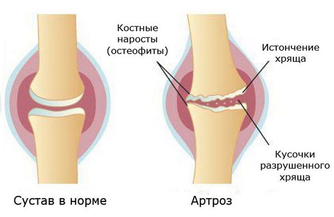 Здоровый и пораженный артрозом сустав Артроз сустава